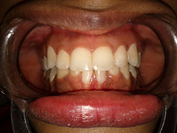 The patient was thrilled with the final result.        