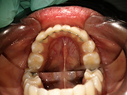 The patient was thrilled with the final result.        