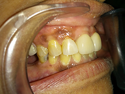 The gap was closed using white composite resin fillings.