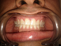 White fillings were added to the front four teeth to close the gap and improve appearance