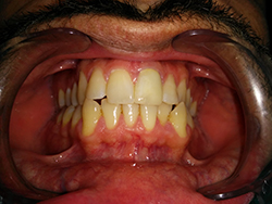 The front tooth after being restored with an aesthetic crown
