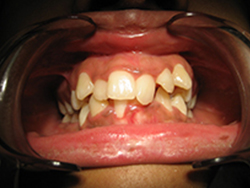 This patient had severe crowding requiring orthodontic treatment