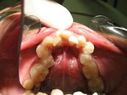 This patient had severe crowding requiring orthodontic treatment