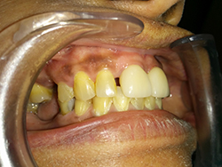 This patient was unhappy with the large space between her front teeth.