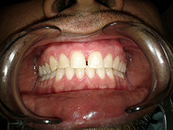 Pt had a large gap between his front teeth                     