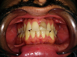 Discoloured and fractured front tooth