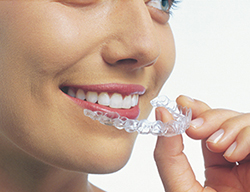 Invisalign